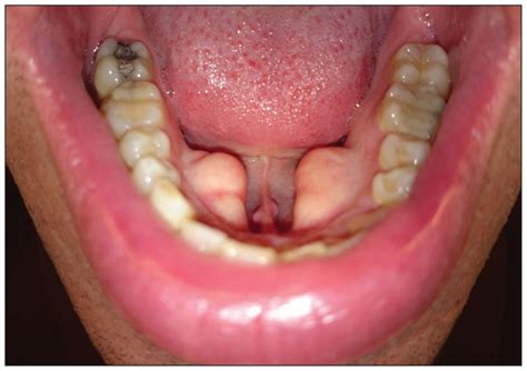 Mandibular torus .
